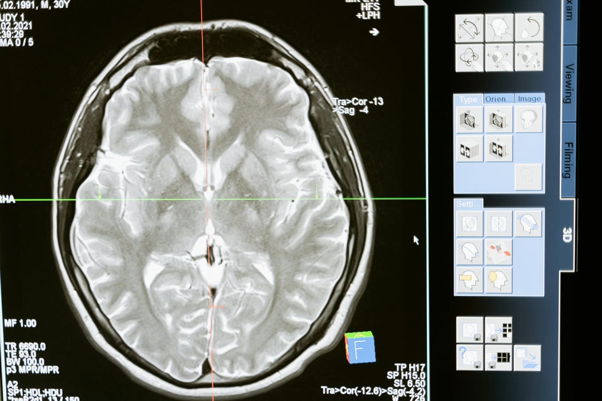 A new brain implant shows progress in helping recovery from traumatic head injuries